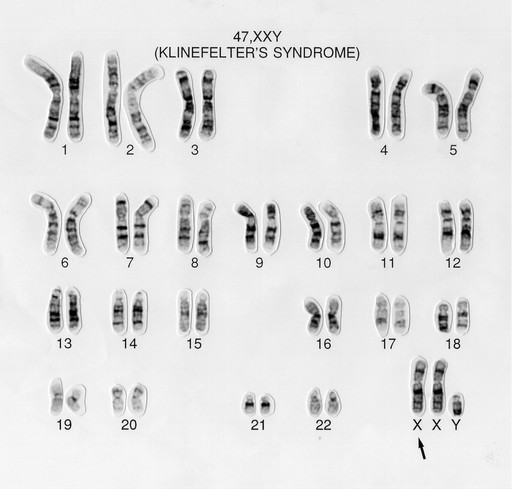 Klinefelter S Syndrome Karyotype 47 Xxy Wessex Reg Genetics Centre